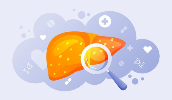 تصویر علمی و آموزشی از کبد چرب با تجمع چربی در سلول‌های کبدی، نشان‌دهنده اثر ریزمغذی‌ها و سبک زندگی بر سلامت کبد